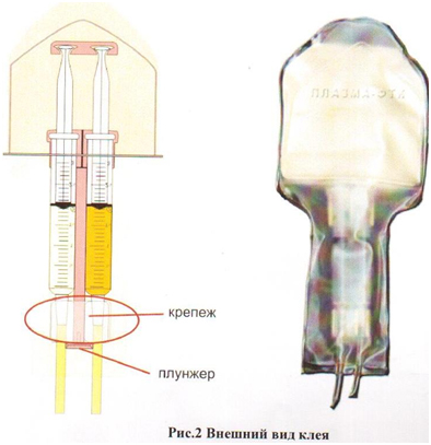 получен из вирусинактивированной плазмы одного донора, состоит из компонентов фибриногена 1мл и тромбина 1мл. Двухкомпонентный хирургический клей «КРИОФИТ